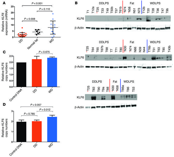 KLF6 is underexpressed in human DDLPS tumors compared with WDLPS tumors....