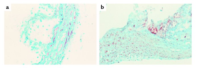 Egr-1 expression in the late lesions of LDLR–/– mice fed a cholesterol-r...