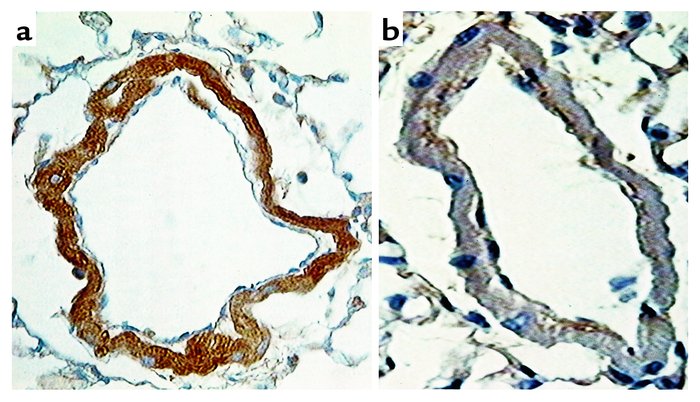 Immunohistochemical localization of 5-HTT in distal pulmonary vessels fr...