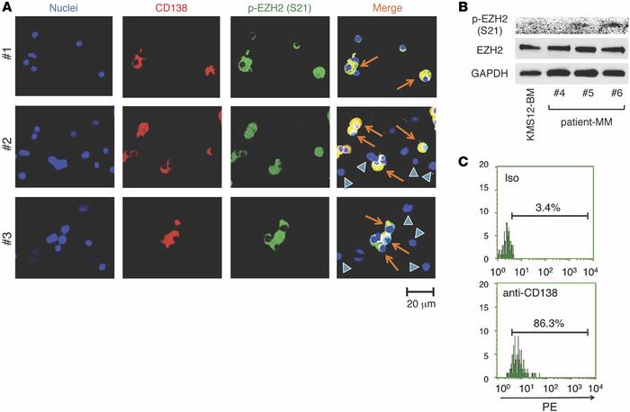 EZH2 was phosphorylated at S21 in CD138-positive BM cells from MM patien...