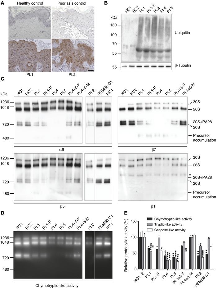 Ubiquitin aggregation and proteasome profile changes in CANDLE/PRAAS pat...