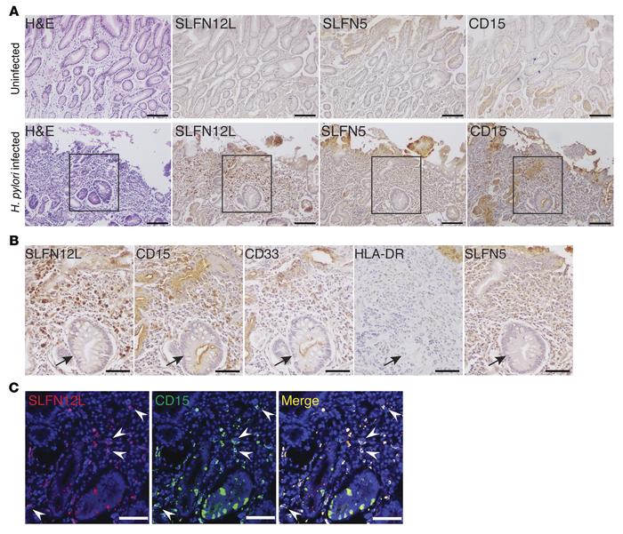 SLFN12L and SLFN5 associated with Gr-MDSCs and intestinal metaplasia in ...