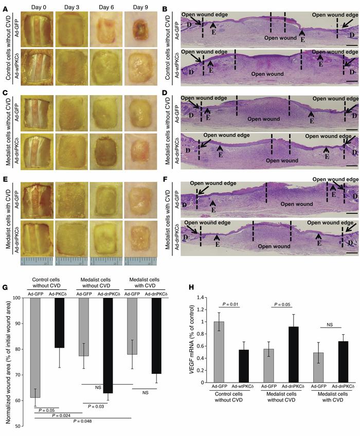 Knockdown of PKCδ in Medalist fibroblasts improves wound healing, while ...