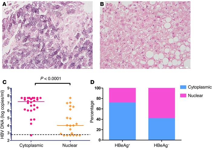 Subcellular localization of HBV DNA signal is highly related to its repl...