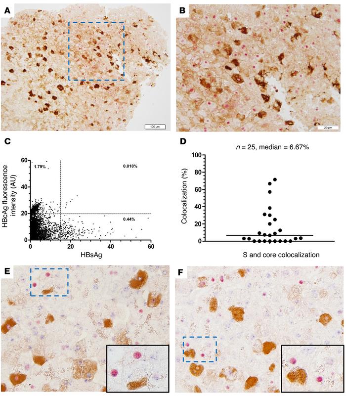 Highly complex distribution of HBsAg, HBcAg, and viral DNA.
Liver sectio...