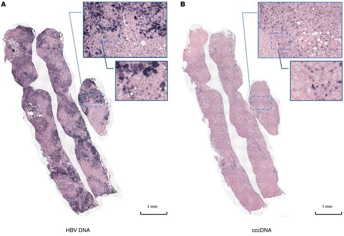 Relationship between HBV DNA and cccDNA.
Whole-tissue scan of HBV DNA (A...