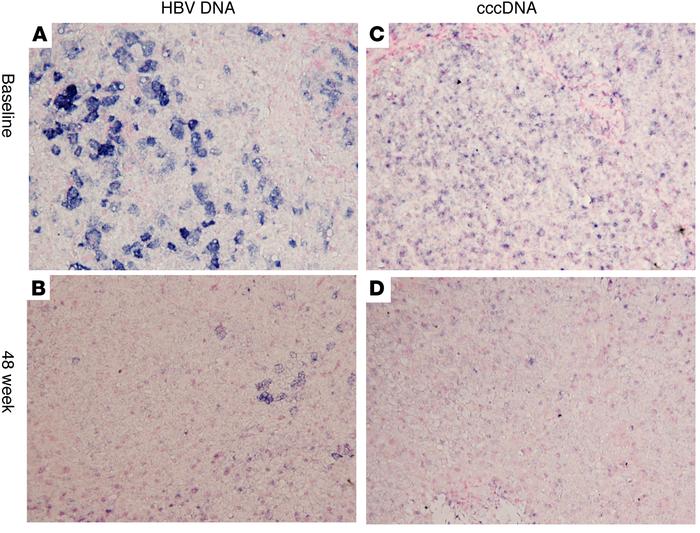 Distribution of HBV DNA and cccDNA before and after adeforvir therapy.
S...
