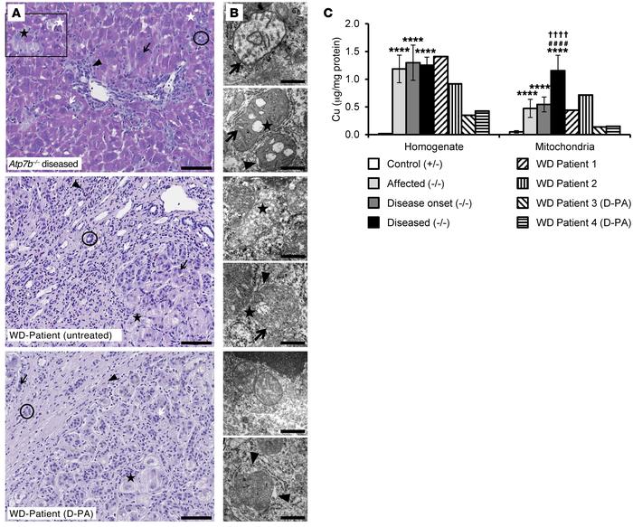 Liver disease in the LPP rat mirrors acute liver failure in WD patients ...