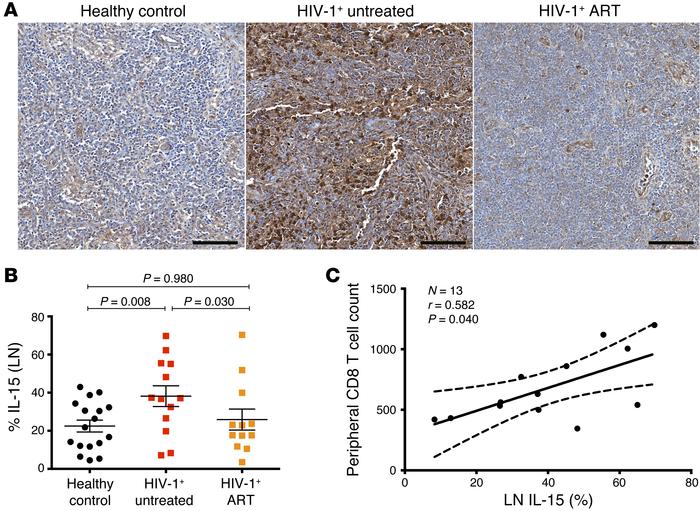 Increased IL-15 expression in LNs of untreated HIV-1–infected patients.
...