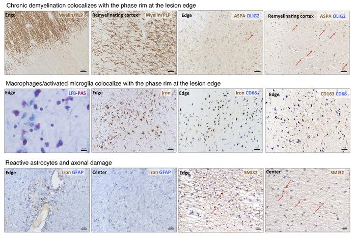 Histological features of MS lesions with phase rim.
Chronic demyelinatio...