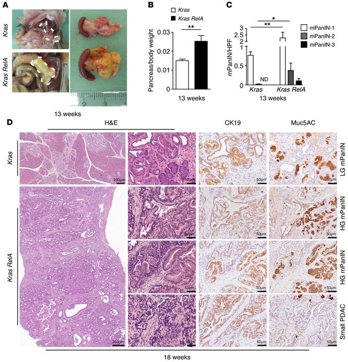 Ablation of RelA accelerates progression of mPanIN lesions.
(A) Represen...