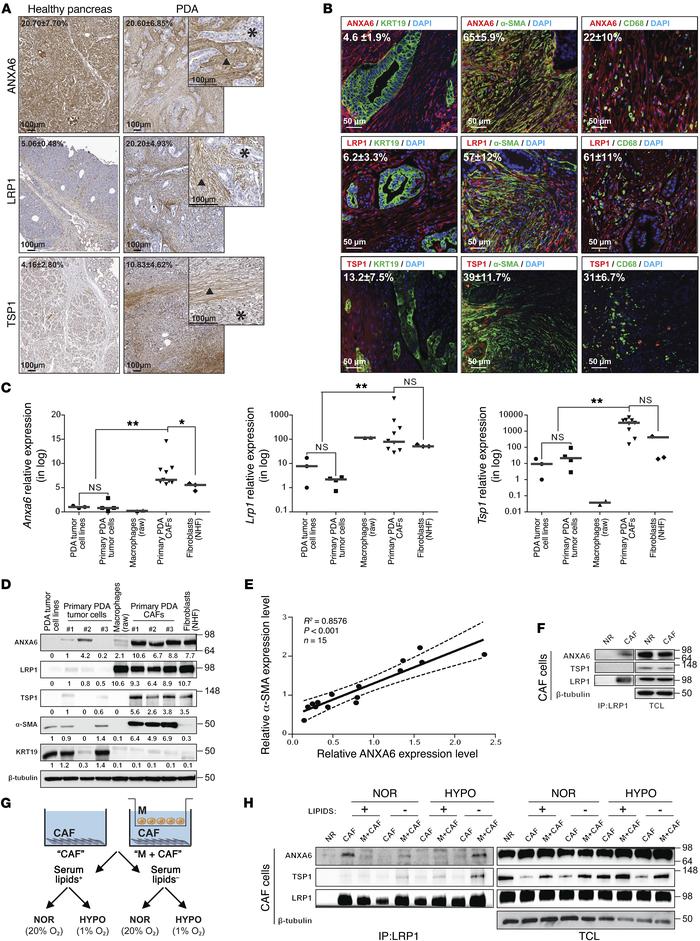 Microenvironment cells, and mainly CAFs, express ANXA6, LRP1, and TSP1 i...