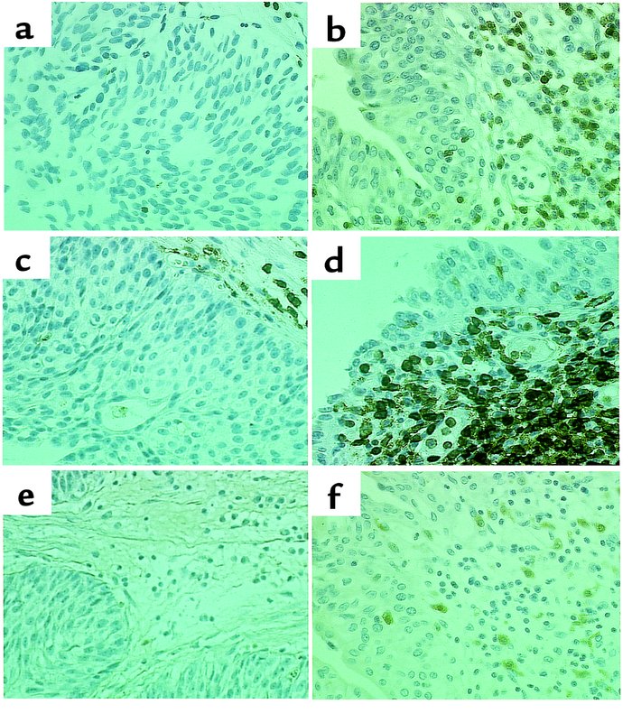 Immunohistochemical staining of bladder from a patient undergoing treatm...