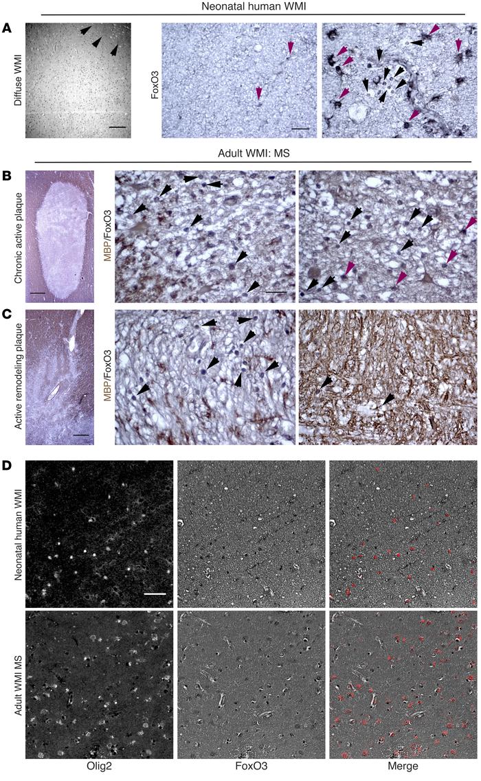 FoxO3 expression is markedly increased in oligodendroglia in chronic hum...