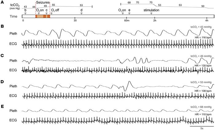 Prolonged postictal hypoventilation in a patient with DS.
(A) Schematic ...