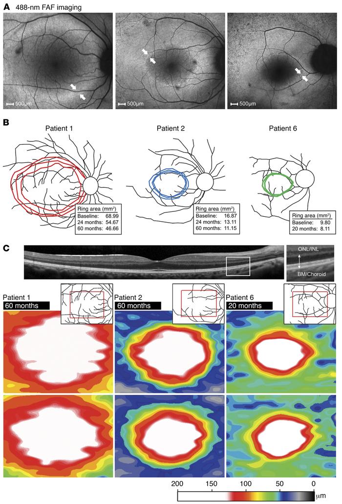 Progressive AF ring constriction and photoreceptor layer thinning in aff...