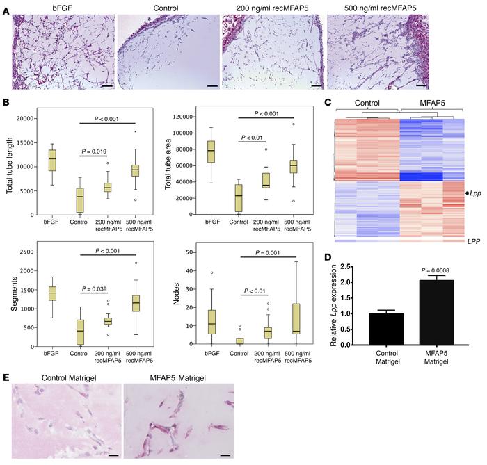 CAF-derived MFAP5 upregulates endothelial LPP expression and promotes an...