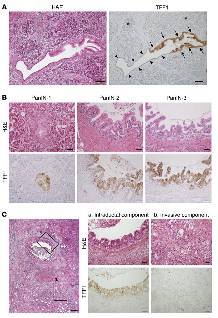 TFF1 expression is lost in the invasive component of pancreatic adenocar...