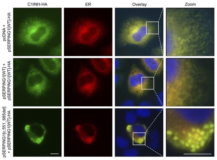 Intracellular retention of C1INH in the ER.
HeLa cells were cotransfecte...