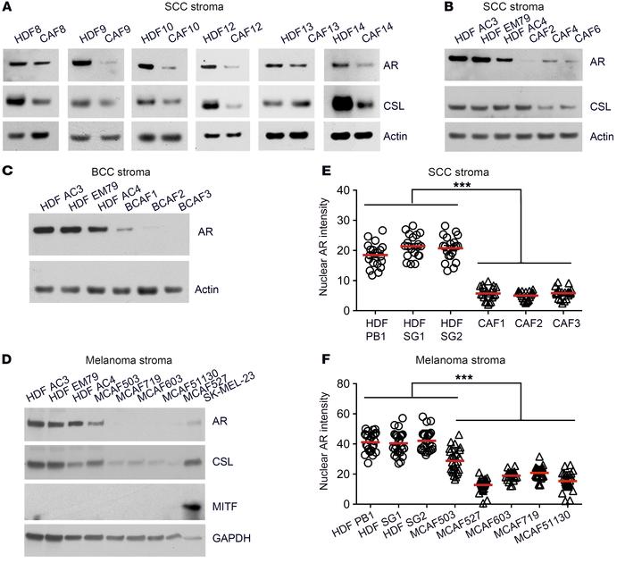 Reduction of AR protein levels is conserved in skin cancer–derived CAFs....