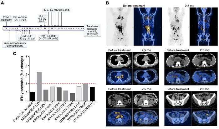 Tumor regression after treatment with KRAS-G12D–based personalized immun...