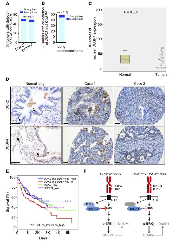 Compound loss of DOK2 and DUSP4 expression and its clinical implication ...